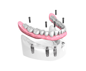 Mise-en-place-des-implants-dentaires-4