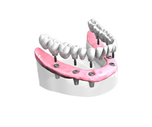 Pose-d-un-bridge-complet-sur-implants-dentaires-All-on-6-5